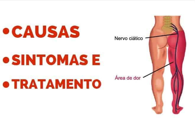 Dor ciática: Causa, Sintomas e Tratamentos 1 CIATICO