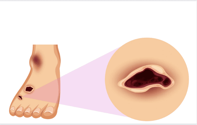 Pé de Atleta (Frieira): Micose nos pés 4 image 1