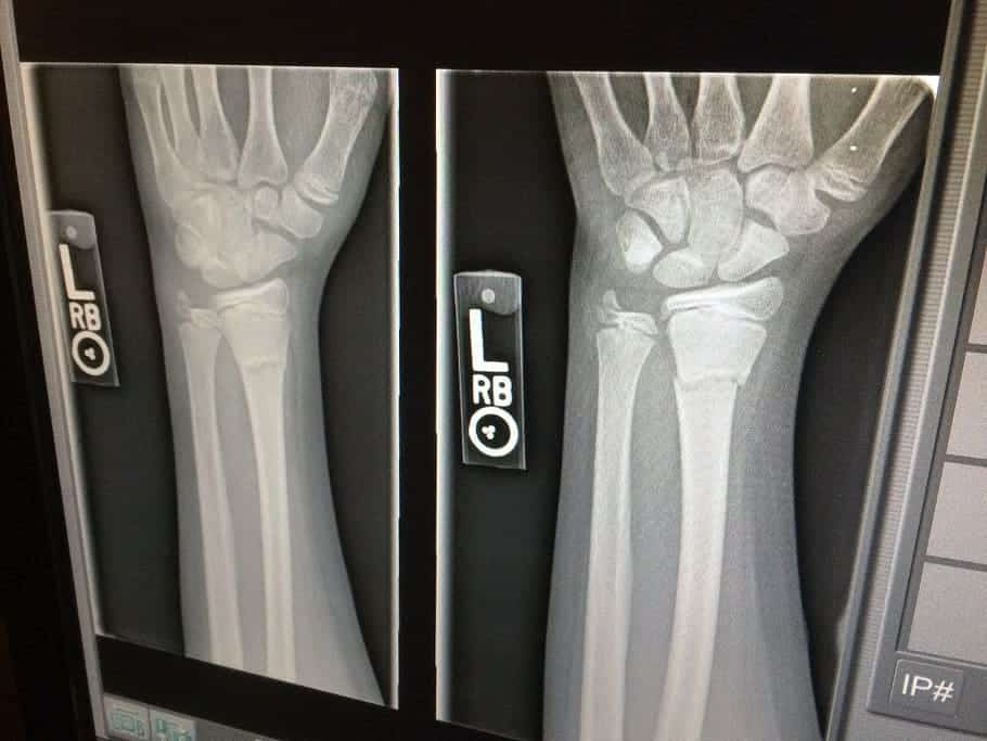x ray medical broken arm
