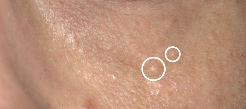 Tratamento para Siringoma 1 tratamento para siringoma