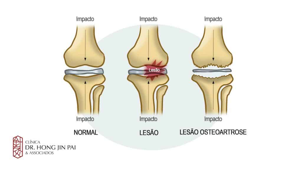 Glucosamina e condroitina para osteoartrite 3 Artrose graus