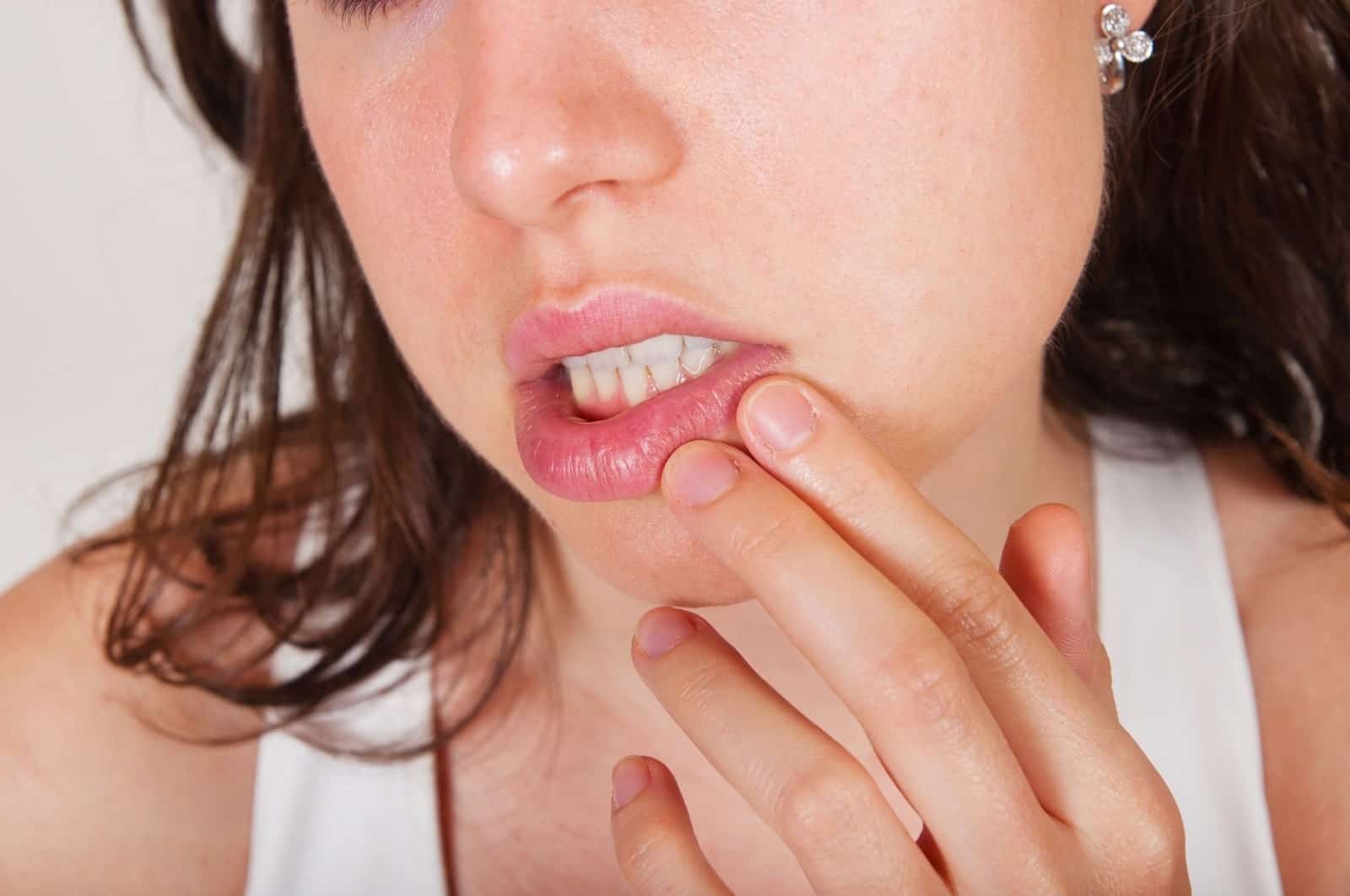 Grânulos de Fordyce 1 Capa Granulos de Fordyce