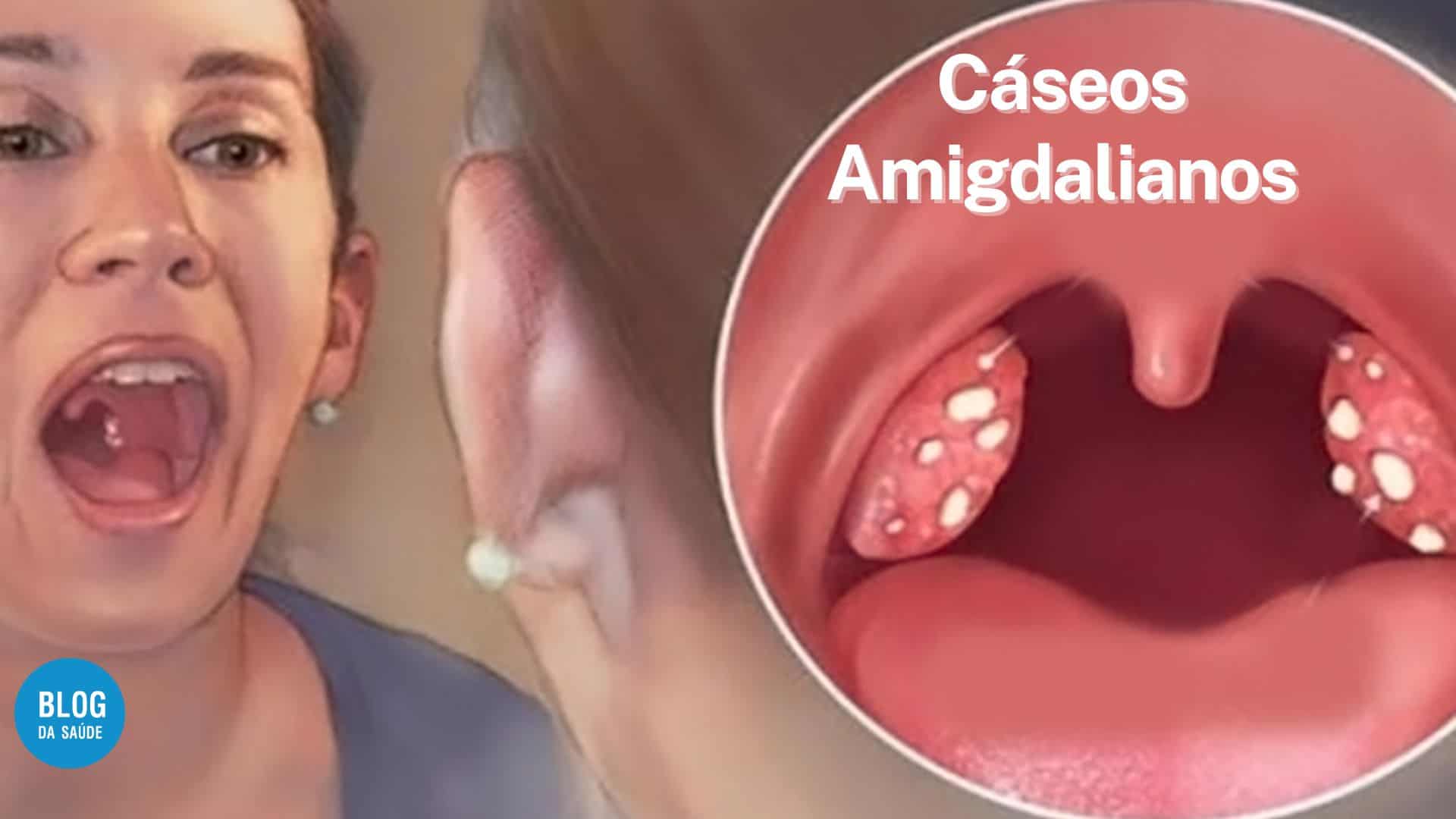 Cáseos amigdalianos