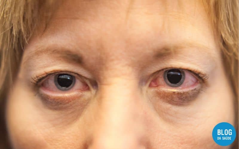 O que é Pupila Dilatada? Entenda! 1 Pupila Dilatada