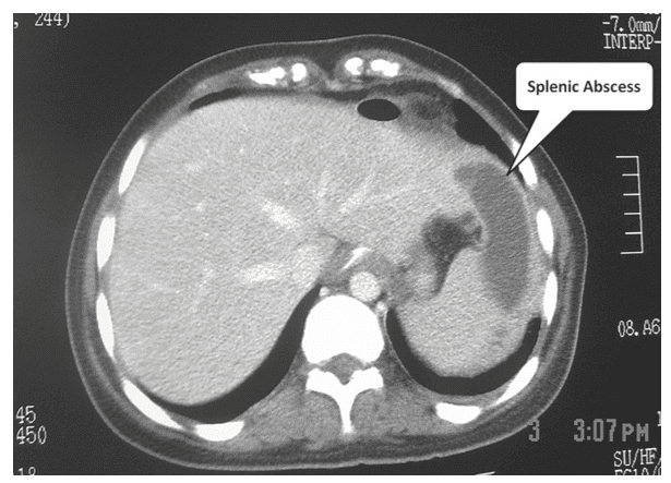 Sinal de Kehr - Dor no ombro por lesão esplênica 3 Abscesso Esplênico e Sinal de Kehr. Fonte: Söyüncü S, Bektas AH, Cete Y. Traditional Kehr's sign: Left shoulder pain related to splenic abscess. ULUSAL TRAVMA VE ACIL CERRAHI DERGISI-TURKISH JOURNAL OF TRAUMA & EMERGENCY SURGERY. 2012;18(1).