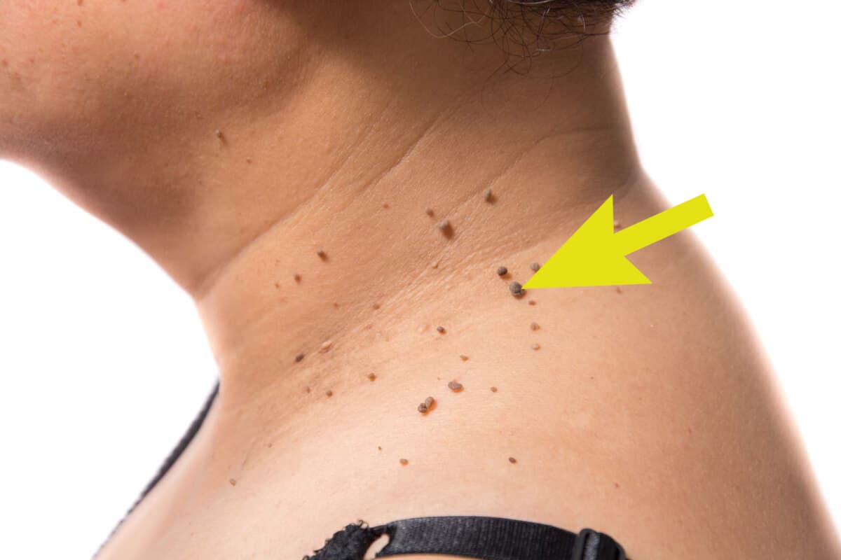 Acrocórdons - Fibromas Moles - Aprenda mais! 1 acrocordons