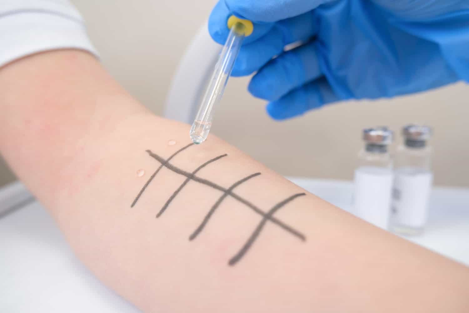 Prick test - Teste de Alergias (Teste Cutâneo) - Aprenda mais 2 aprenda mais prick test