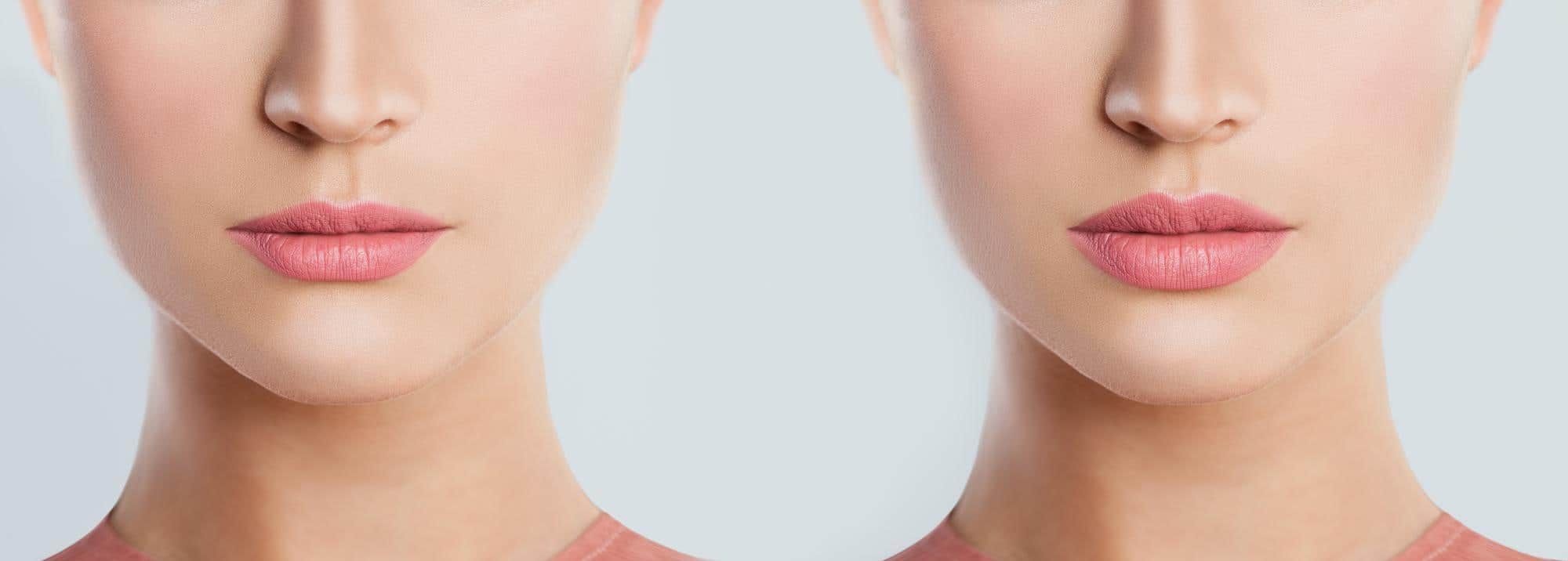 before and after female lip filler injections fillers lip augmentation beautiful perfect lips sexy mouth beautiful young woman lips close up