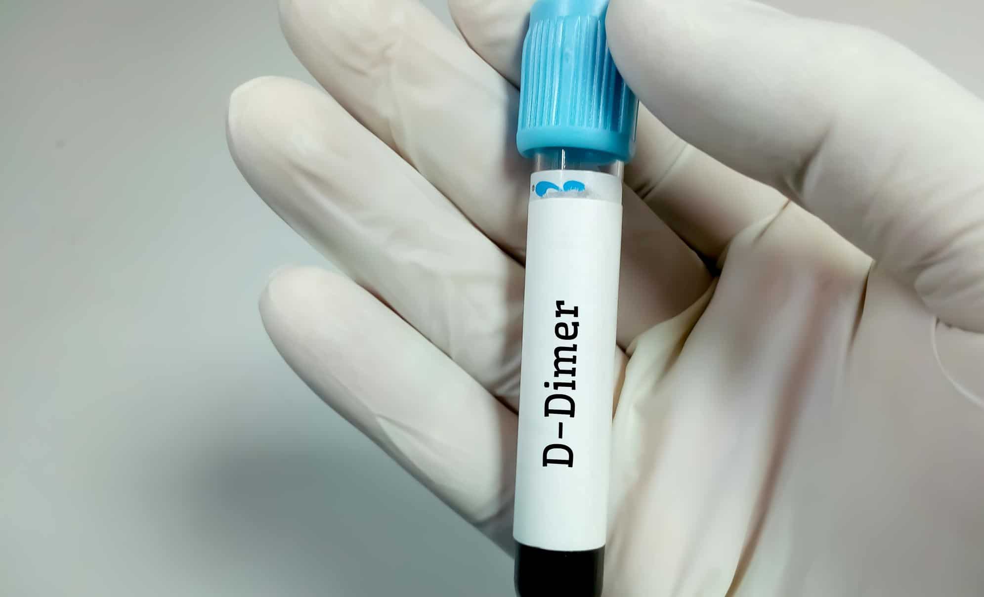 D-Dímero: conheça este importante exame na era covid! 1 blood sample for d dimer test coagulation test 1