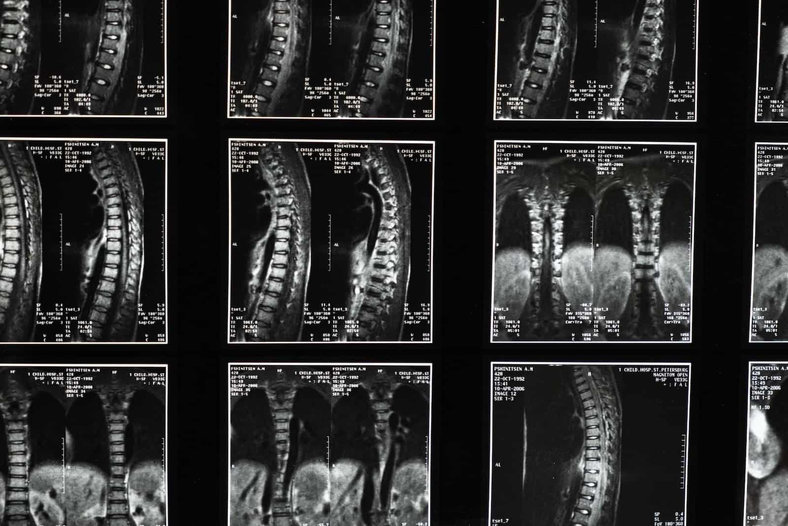 coluna travada lombalgia