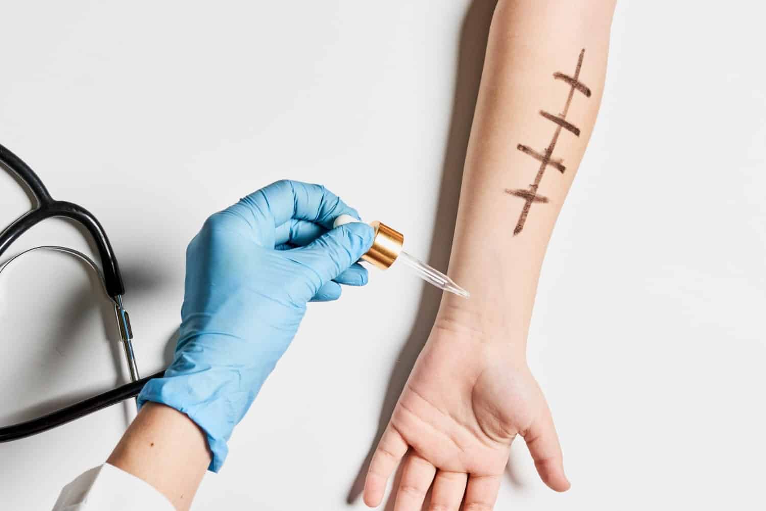 Prick test - Teste de Alergias (Teste Cutâneo) - Aprenda mais 3 como funciona prick test