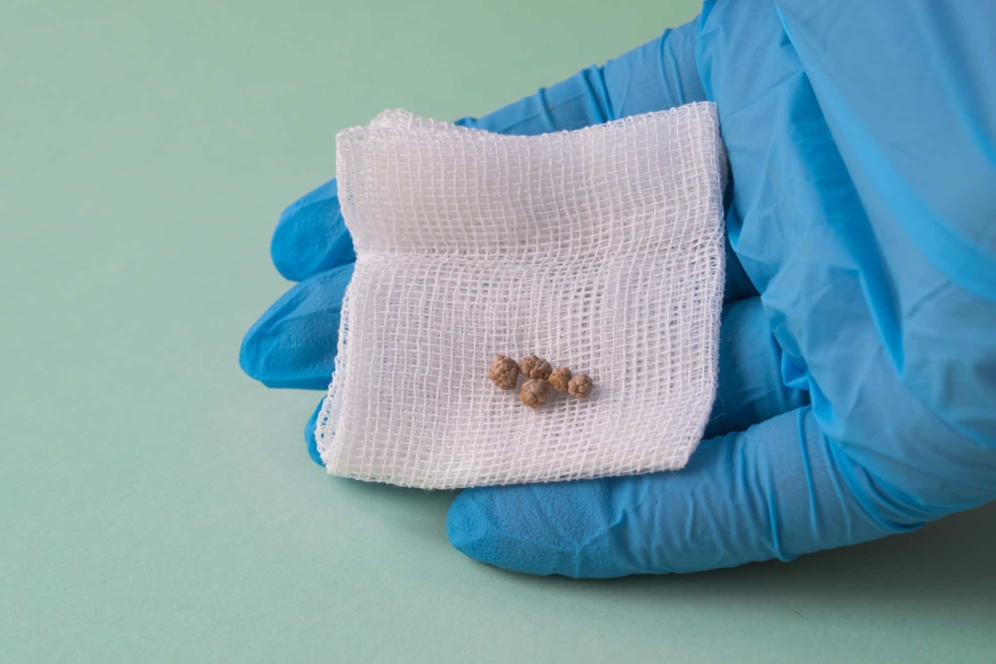 sintomas de pedra na vesícula