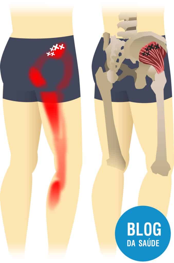 dor miofascial gluteo medio