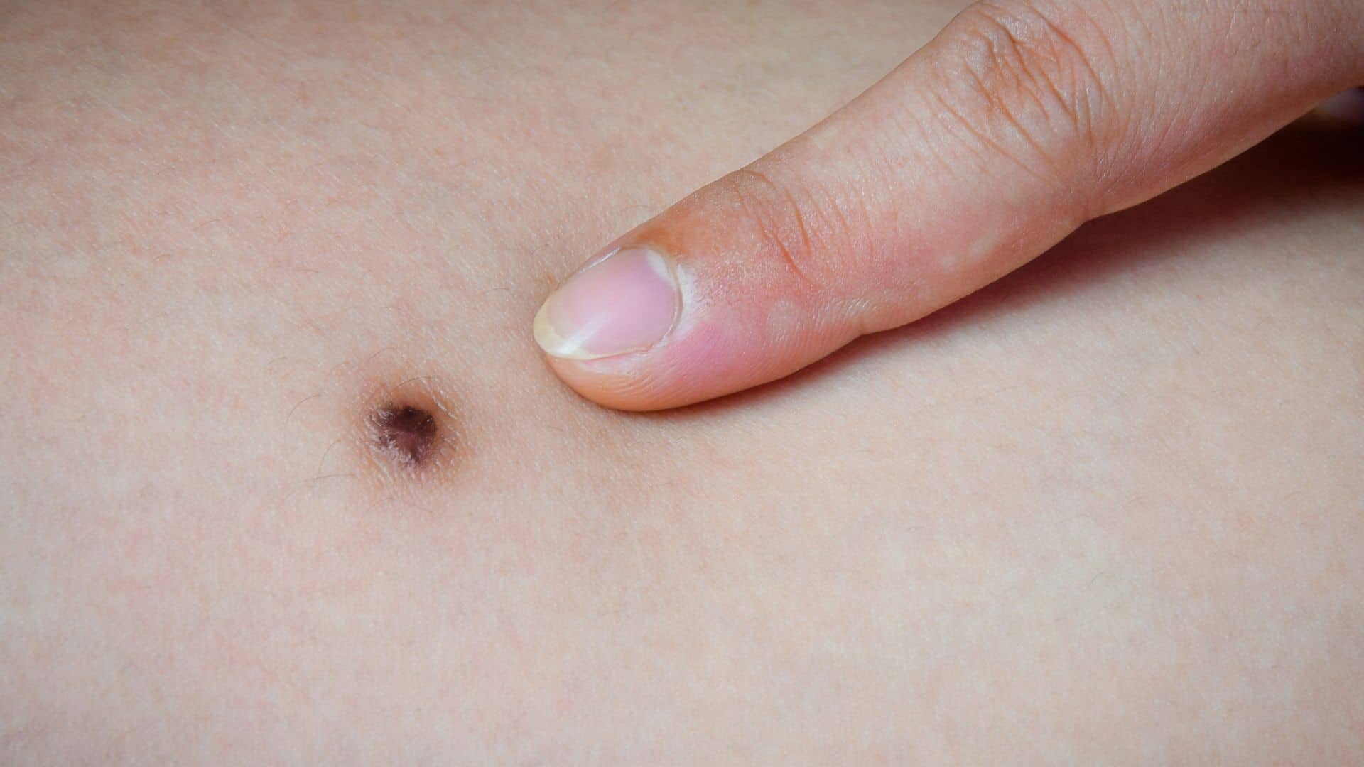 Tipos de manchas na pele