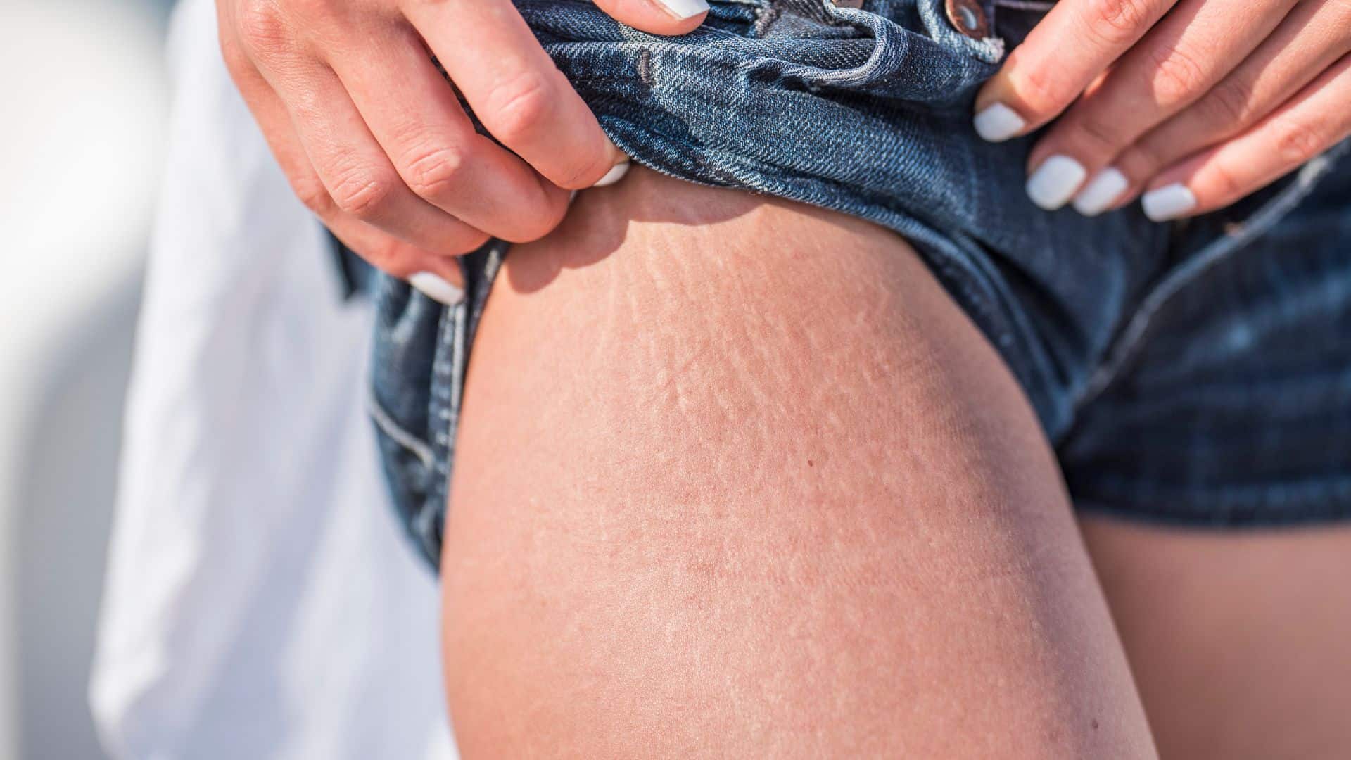 Tratamentos para estrias: conheça os melhores 1 Tratamentos para estrias