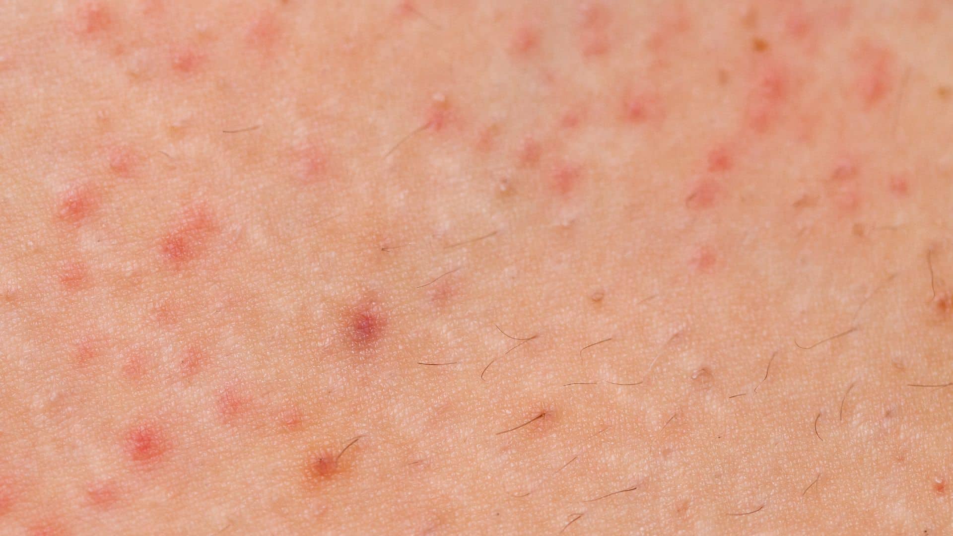 Tratamento para foliculite