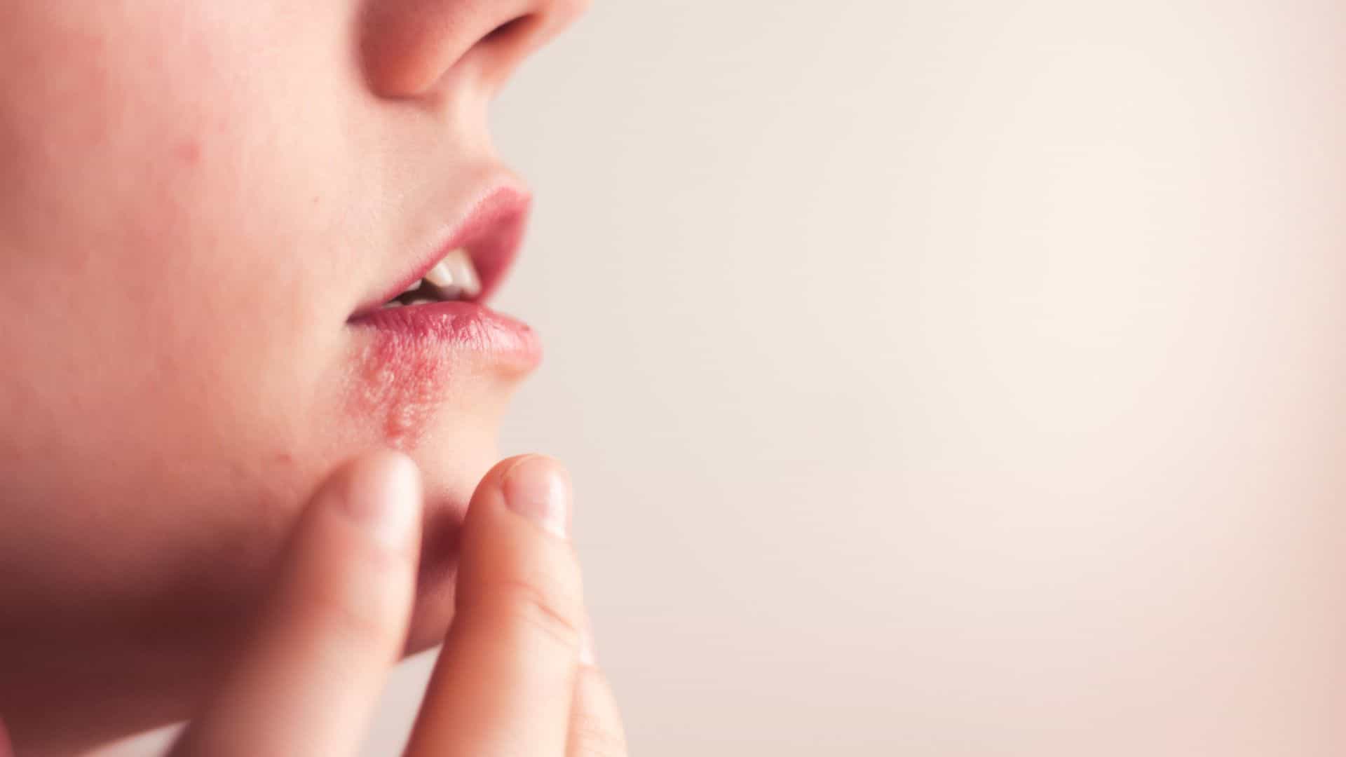 Tratamento para herpes simples