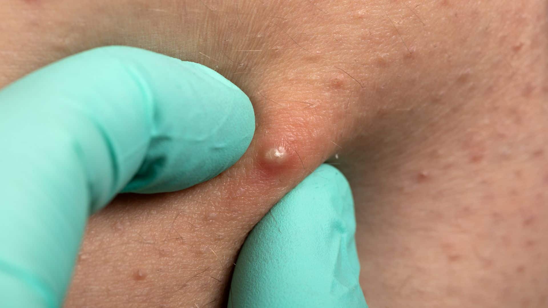 Tratamento para furúnculo