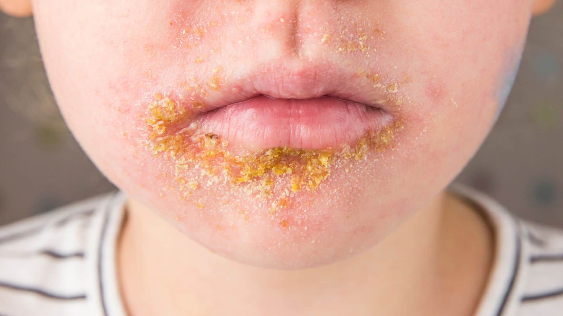 Saiba mais sobre o tratamento para impetigo 1 tratamento para impetigo