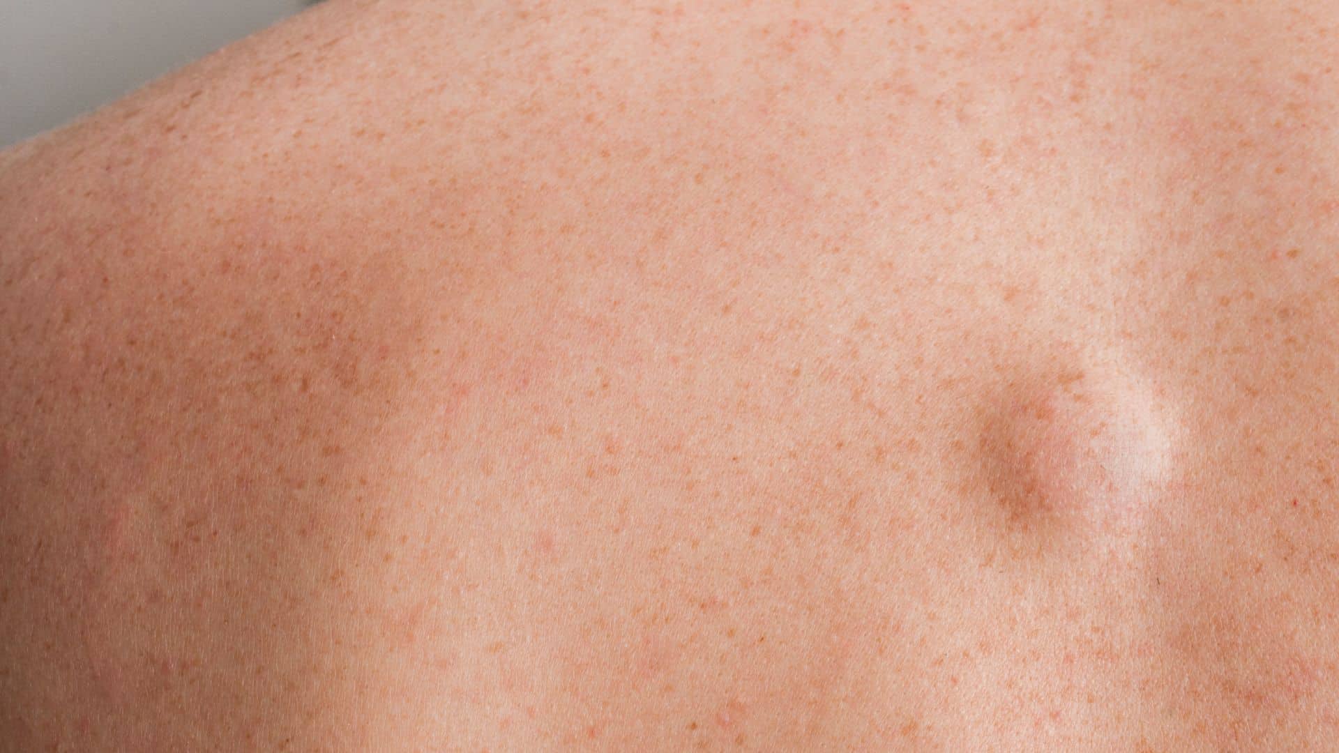 Tratamento para lipoma