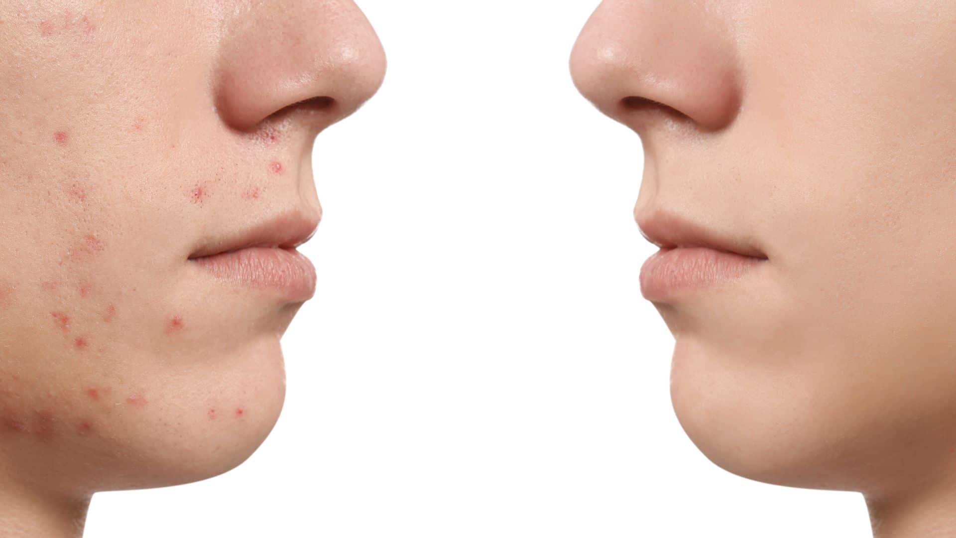 tratamentos para manchas no rosto