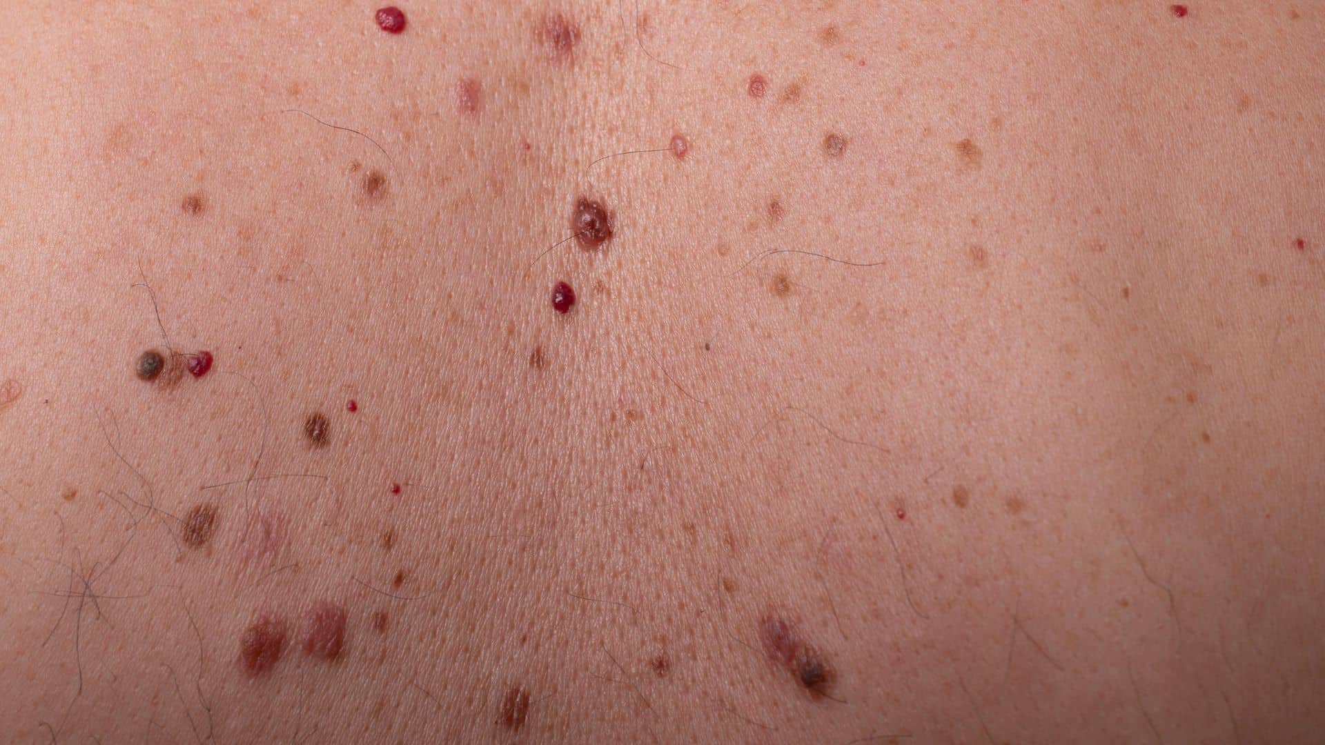 Tratamento para nevos e pintas 1 Tratamento para nevos e pintas