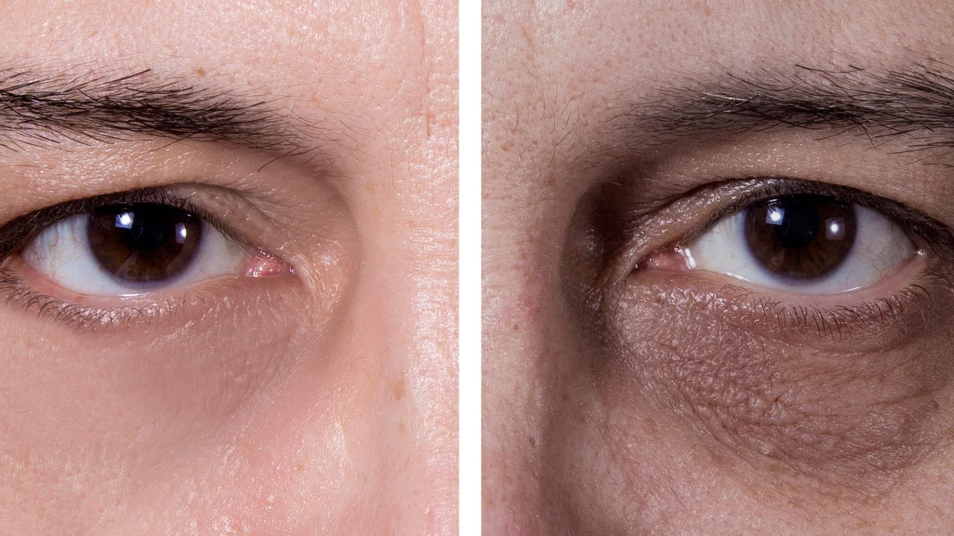 Tratamento para Olheiras Profundas