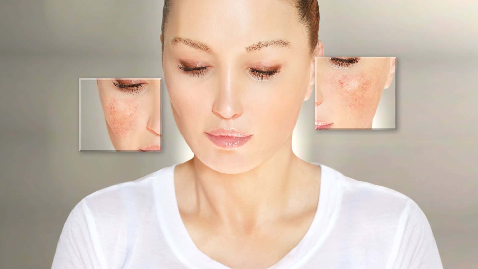 tratamento para rosácea