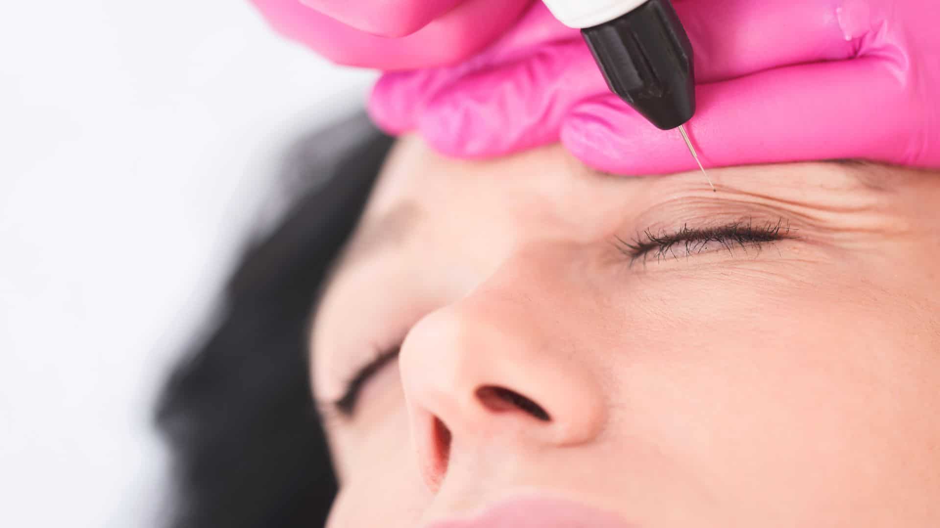 tratamento para xantelasma