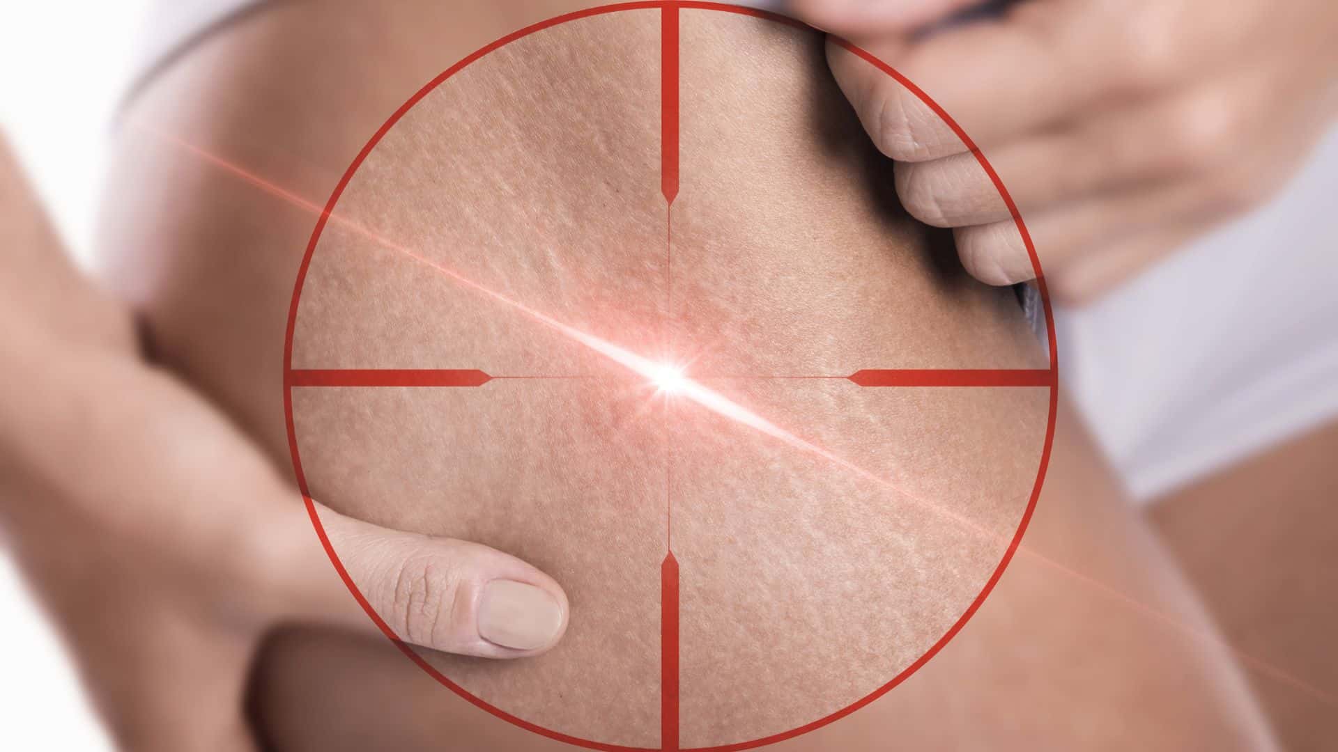 Tratamento a Laser para Estrias