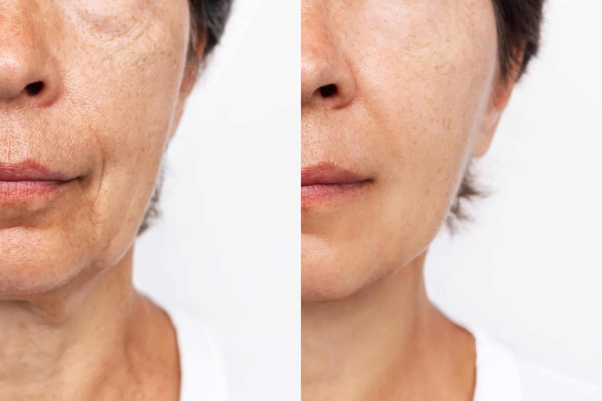 Fios de sustentação: conheça os benefícios e vantagens desta técnica! 1 lower part of elderly woman s face and neck with signs of skin aging before after facelift surgery