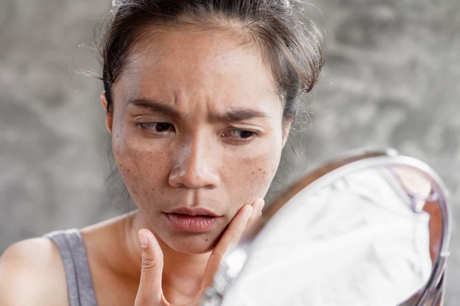 Melasma: Opções de tratamento 1 melasma c