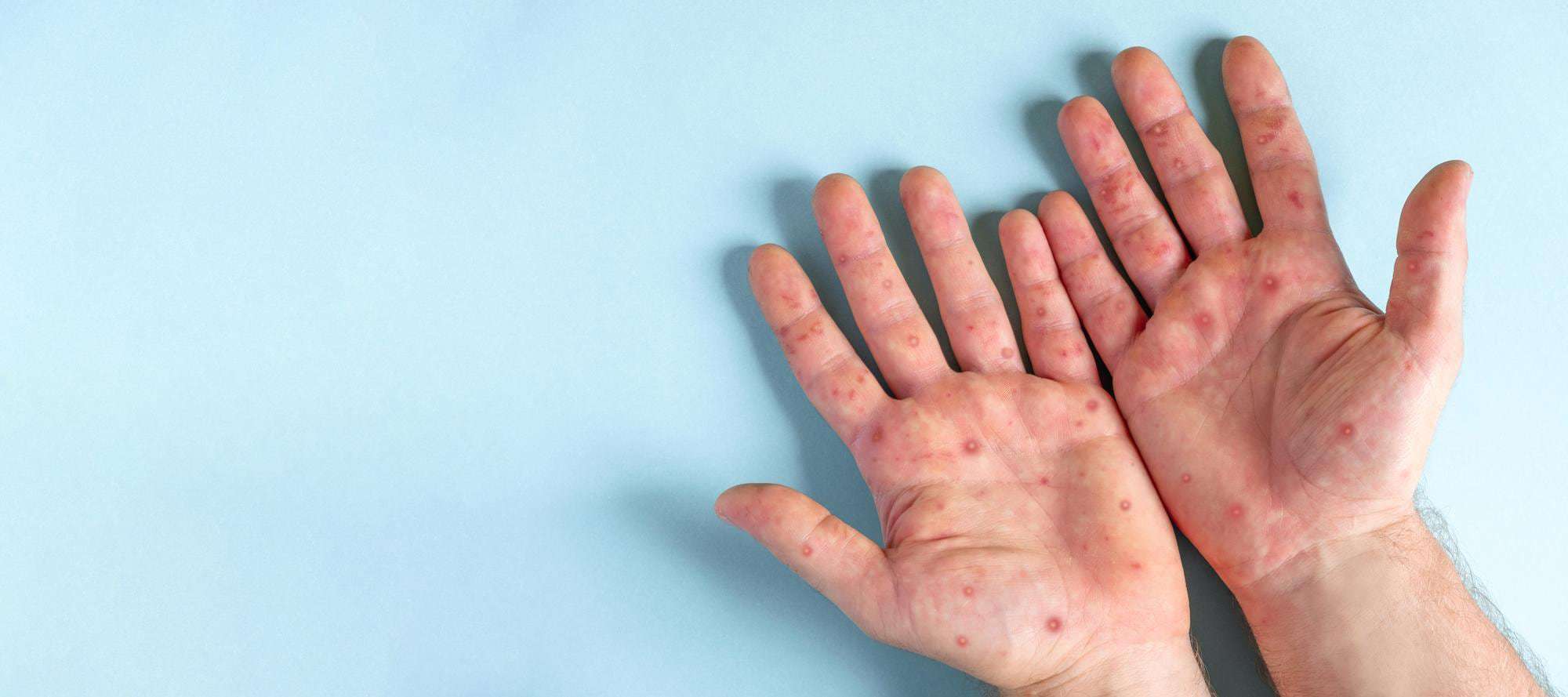 monkeypox disease patient with monkey pox rash on hand close up rash human hands banner copy space 1