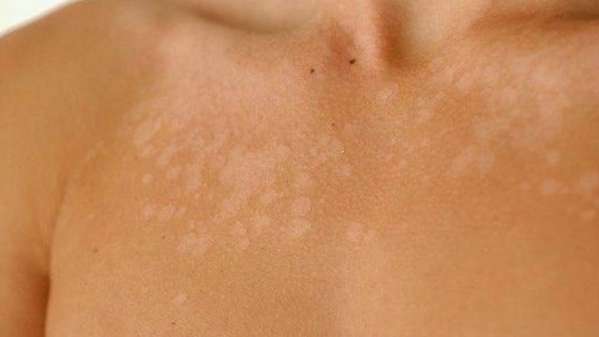 Pano Preto na Pele: O que é? Diagnóstico e Tratamento 1 pano preto na pele