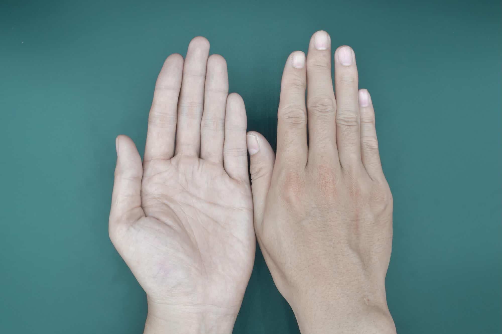 Síndrome de Raynaud (Fenômeno de Raynaud) - O que É? Sintomas e Tratamentos 1 sindrome fenomeno de raynaud