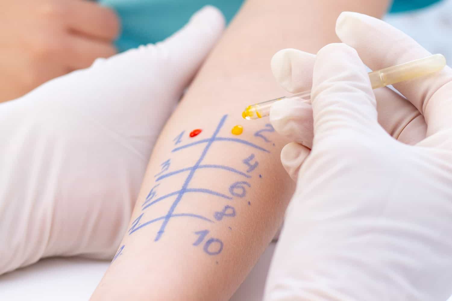 Prick test - Teste de Alergias (Teste Cutâneo) - Aprenda mais 5 teste de alergias cutaneas prick test
