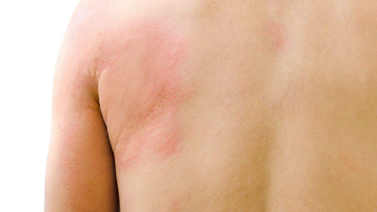 Urticária Colinérgica - O que é? Causas, Sintomas e Tratamentos 1 urticaria colinergica